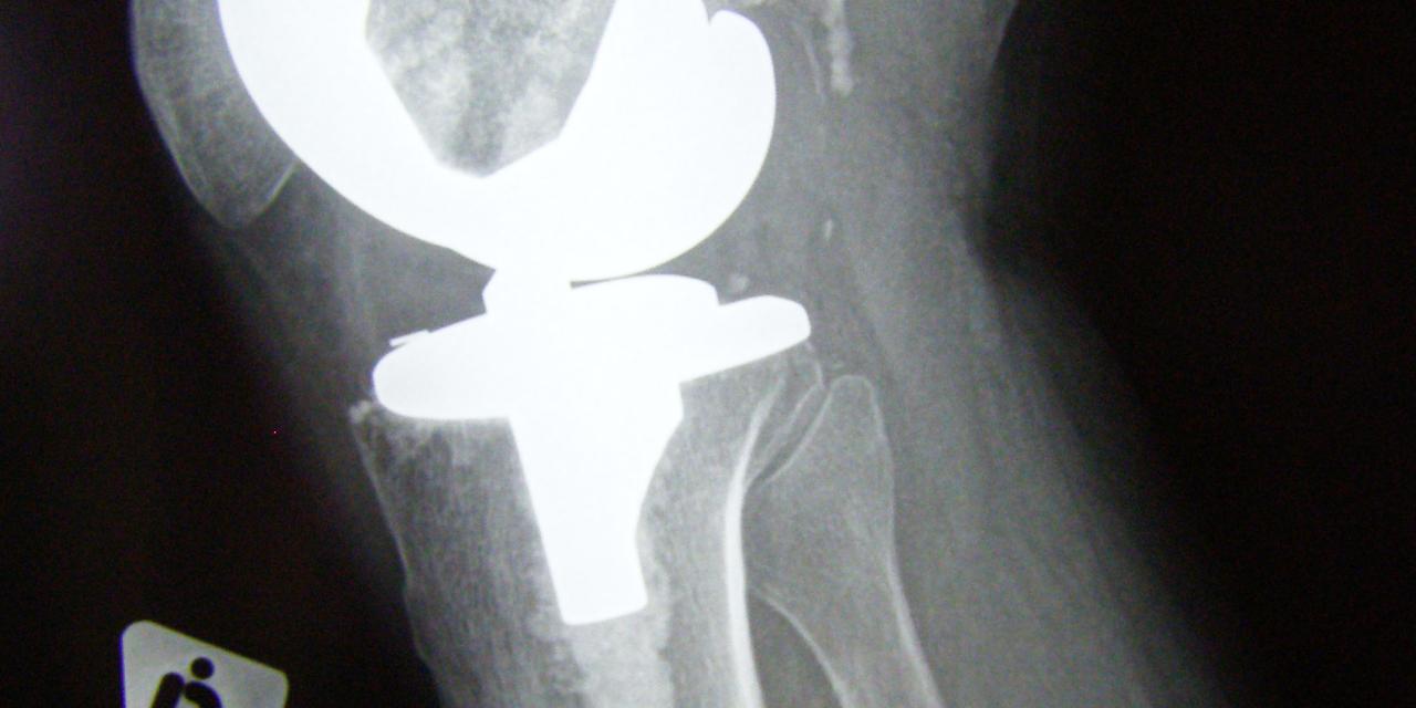 Proefpersonen gezocht voor onderzoek jumpers knee 