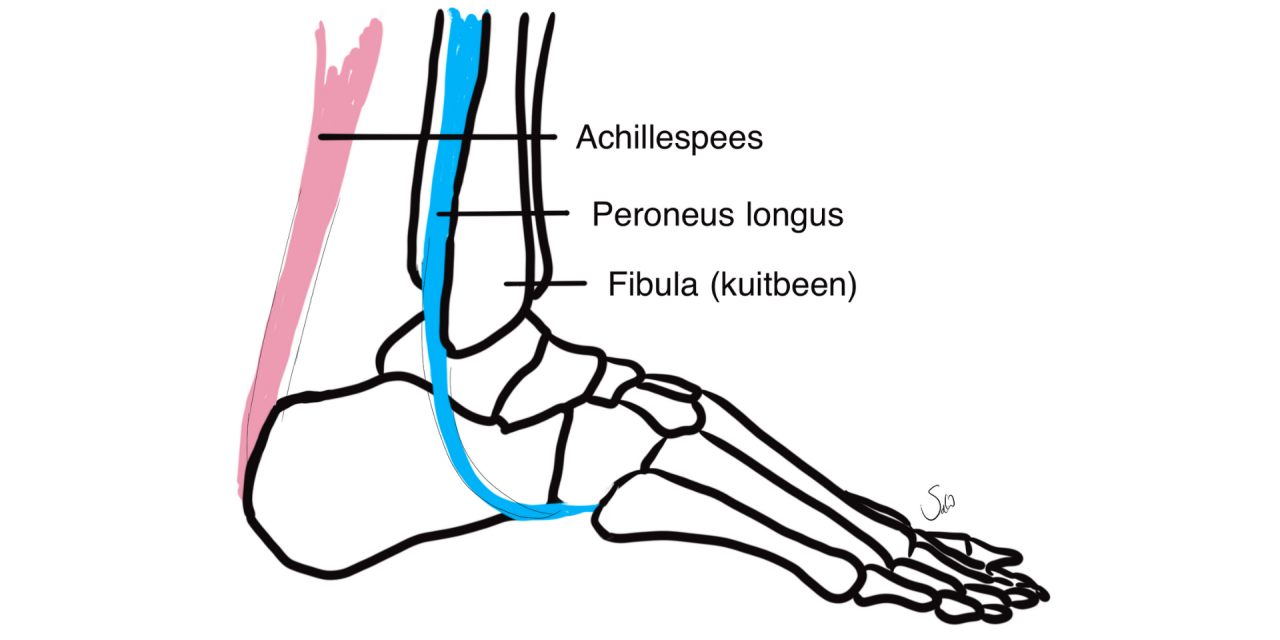 Blog: De achillespeesblessure anders bekeken