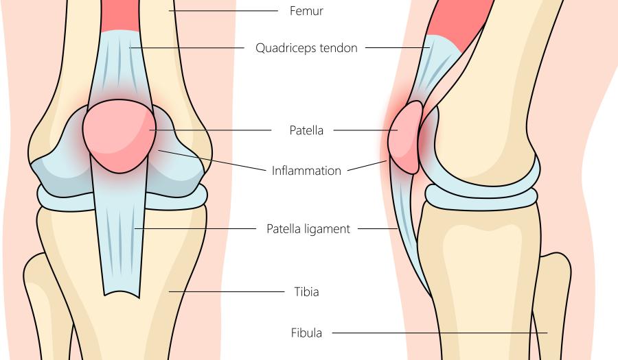 Medische illustratie van knie met pijn rond de knieschijf, passend bij patellofemoraal pijnsyndroom symptomen