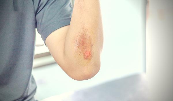 Wat Te Doen Aan Schaafwond